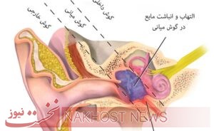 التهاب گوش میانی را بشناسید