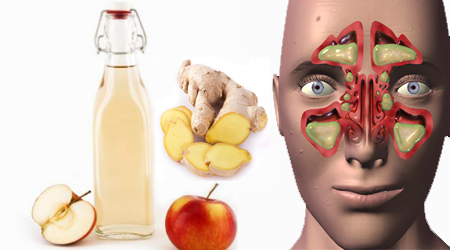 سینوزیت در ورزشکاران