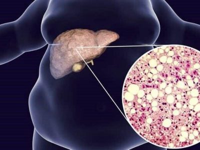 علائمی که نشان می دهد شما یک قدم به کبد چرب نزدیک شدید