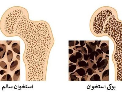 این علائم یعنی شما به پوکی استخوان مبتلا شدید