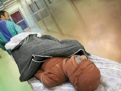 سوختگی در ایران؛ آماری فراتر از حادثه